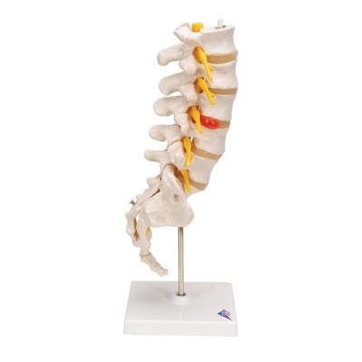 3B Scientific Lumbar Spine Model with Dorso-Lateral Prolapsed Intervertebral Disc